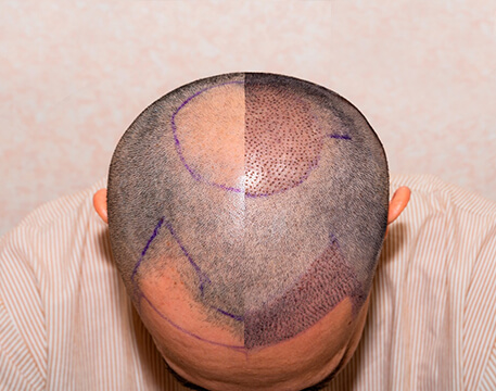 GREFFE DE CHEVEUX